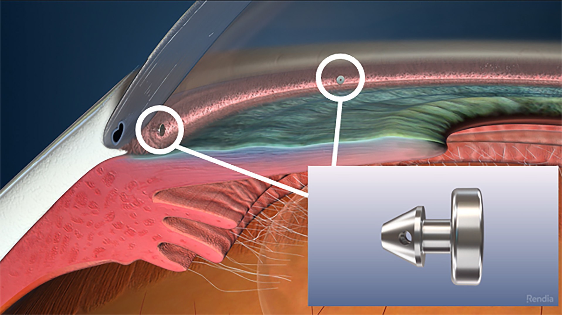 Glaucoma And Ocular Surface Disease