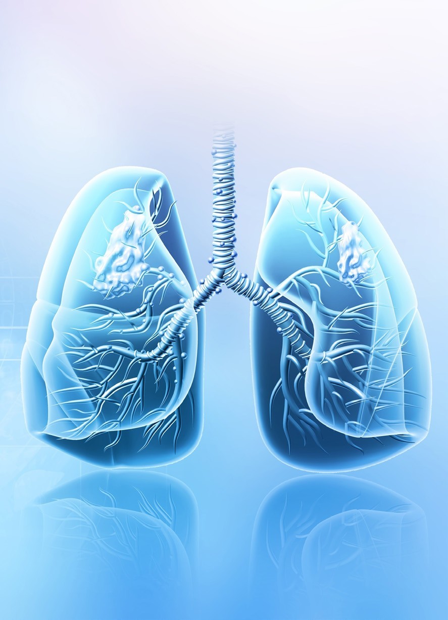 EC approves AstraZeneca’s Tagrisso for lung cancer treatment