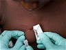 Global monkeypox cases rise to 26,000