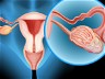 Promising ovarian cancer drug enters phase 3 trial
