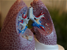 Pulmonx Secures Japanese Approval For Zephyr Valve For COPD/Emphysema